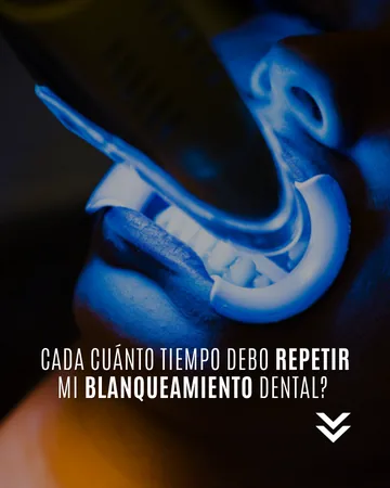 Publicación: cada cuánto repetir el blanqueamiento dental