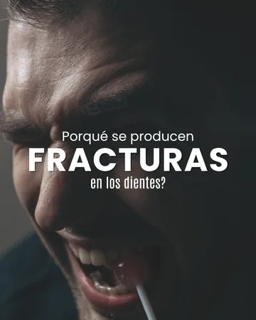 Portada de carrusel: por qué se producen fracturas en los dientes