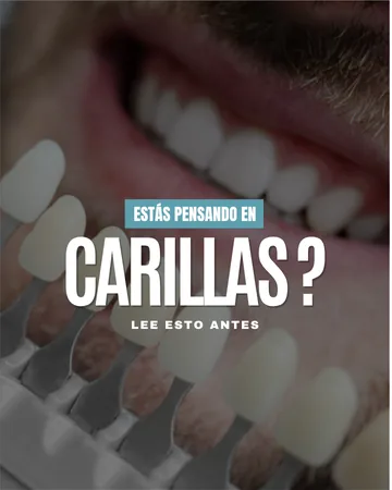 Publicación: ¿estás pensando en carillas?